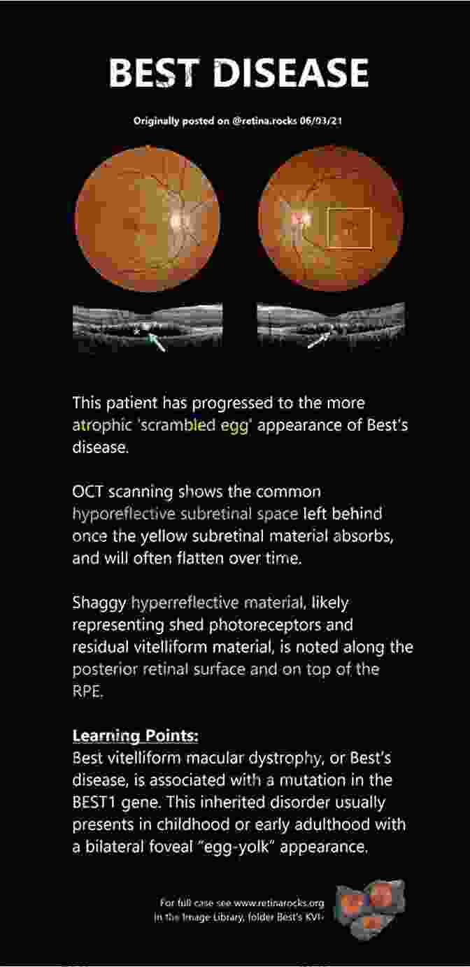 Akira Nakano, A Renowned Ophthalmologist Specializing In Inherited Retinal Diseases Inherited Retinal Disease Akira Nakano