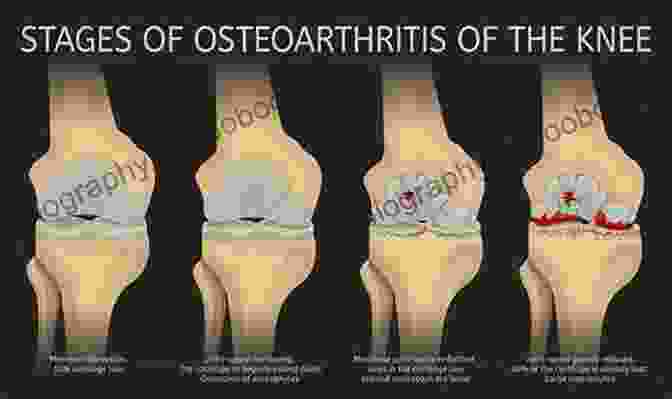 Progression Of Cartilage Damage In Osteoarthritis The Illustrative Of Cartilage Repair