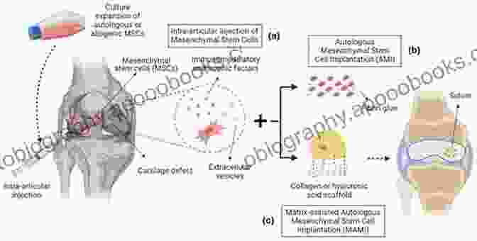 Stem Cell Therapy For Cartilage Repair The Illustrative Of Cartilage Repair