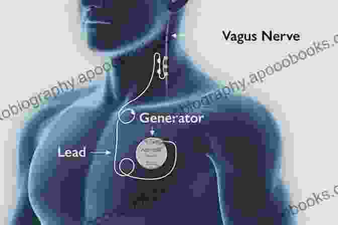 Vagus Nerve Stimulation Device Implanted In The Chest Stimulation Of The Peripheral Nervous System: The Neuromodulation Frontier (Progress In Neurological Surgery 29)